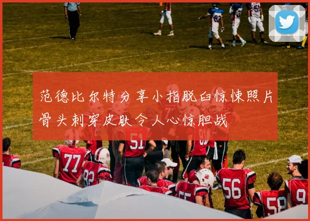 范德比尔特分享小指脱臼惊悚照片骨头刺穿皮肤令人心惊胆战